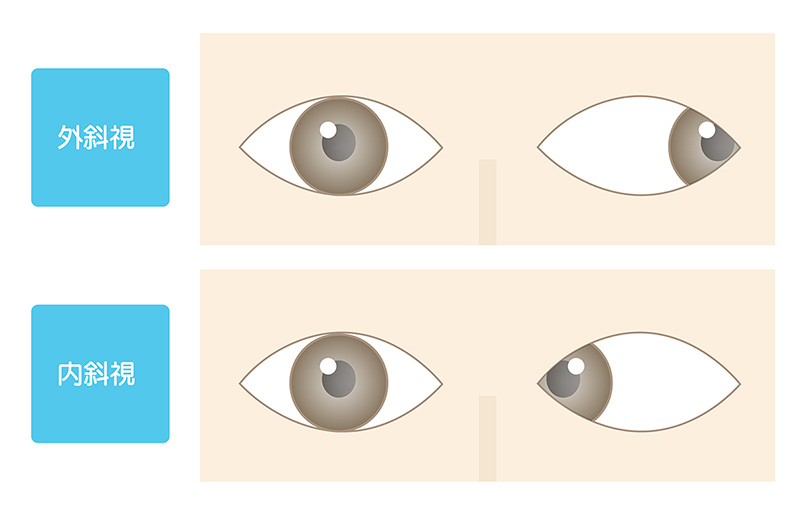 外斜視と内斜視
