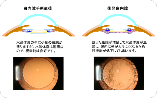 後発白内障の発症のメカニズム