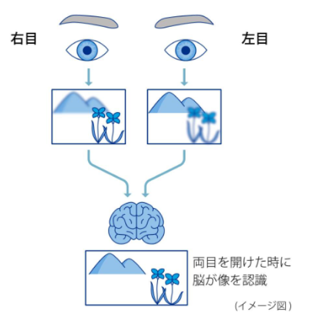 モノビジョンでは： • 利き目 → 遠くを見る用に調整（ピントを遠方に） • 反対の目 → 近くを見る用に調整（ピントを手元に） 設定するが、その際の見え方