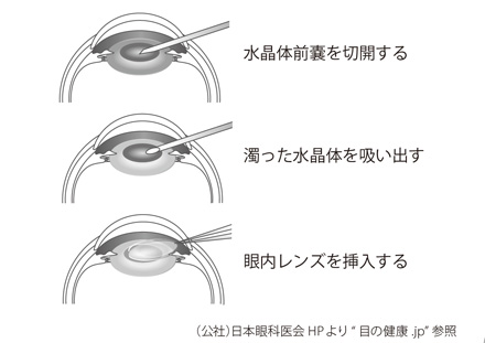 白内障手術で眼内レンズを入れる